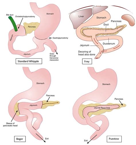 A Clinical Overview of Acute and Chronic Pancreatitis: The Medical and ...