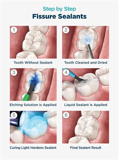 Fissure sealants and their importance