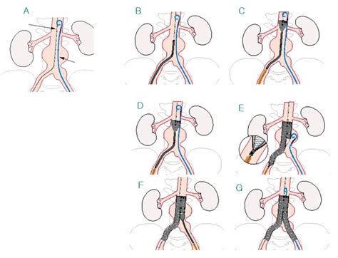 EVAR procedure