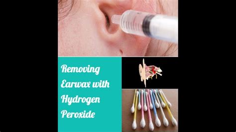 How To Use Hydrogen Peroxide Eardrop To Remove Impacted Ear Wax Buildup ...