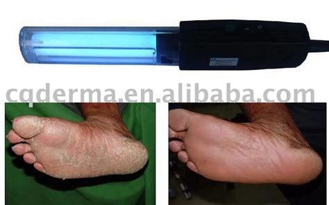 Uv Light Treatment For Psoriasis Reviews | Shelly Lighting