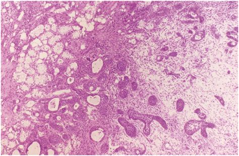 Necrotizing Sialometaplasia