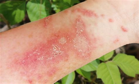 What Is Poison Ivy? Symptoms, Causes, Diagnosis, Treatment,