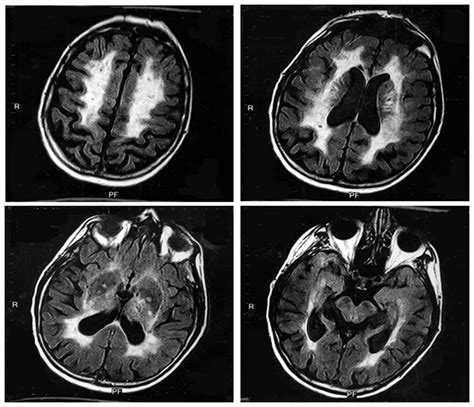 Bilateral small chronic infarcts and patchy and confluent areas of... | Download Scientific Diagram