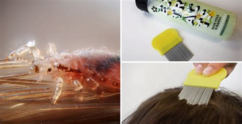 How To Get Rid Of Nits (Head Lice Treatments That ACTUALLY Work!) - Expert Home Tips