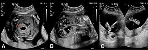 Three images of the first anomaly scan at 21 weeks of gestation in... | Download Scientific Diagram