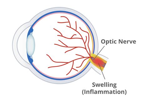 Papilledema (Optic Disc Swelling): Causes Symptoms, 47% OFF