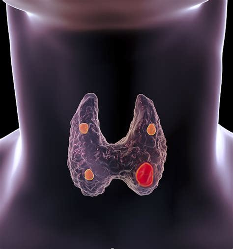 Primary Hyperparathyroidism