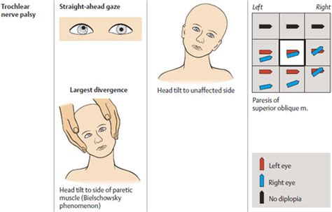 Cranial Nerve Palsy Causes