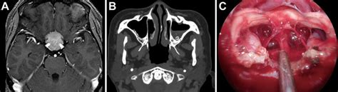 A: MRI reveals a tuberculum sellae meningioma compressing the anterior ...