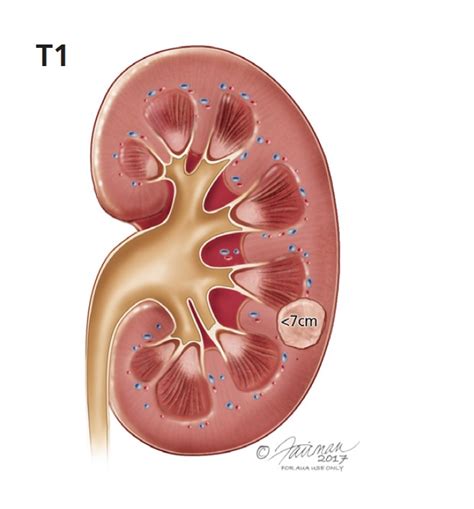 How To Cure Kidney Cancer - Internaljapan9