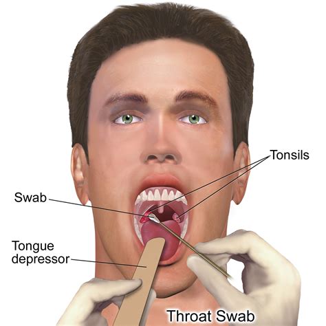 Tonsillitis