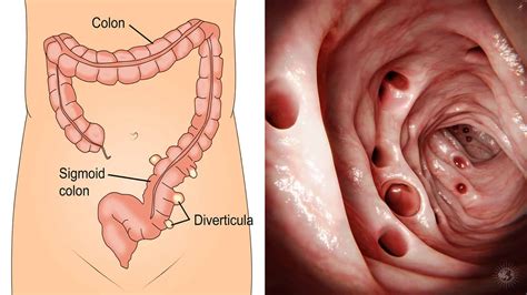 7 Symptoms of Diverticulitis (And Natural Remedies To Help Fix It) | Power of Positivity