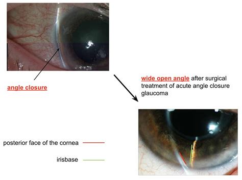 What is acute angle-closure glaucoma ? | Belgian Glaucoma Society