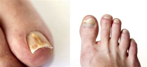 Fungus Toenails - Toenail Fungus Treatment Phx | Preferred Foot & Ankle