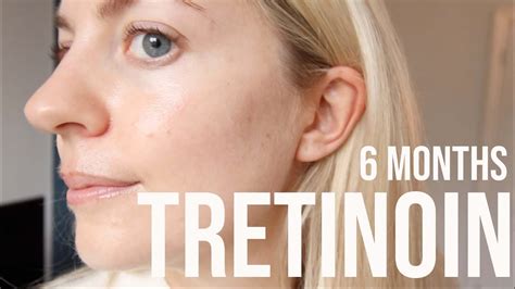 Tretinoin Before After, Before and after month 2 on 05% tretinoin cream ...