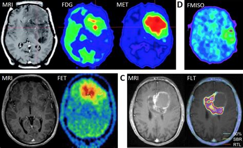 An Overview of Brain Tumours | Brain Tumour Research Centre | UiB