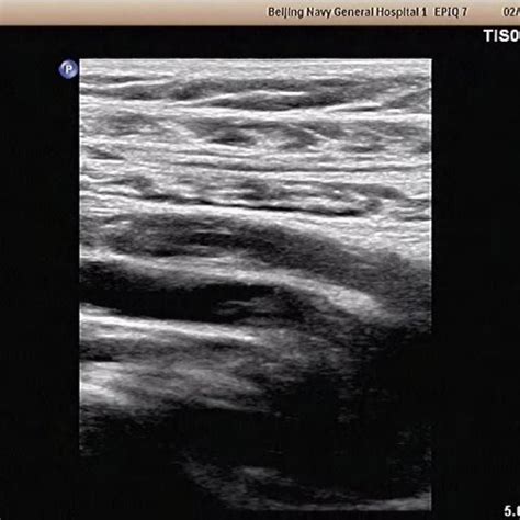 Doppler ultrasound revealed a deep venous thrombosis in the right ...