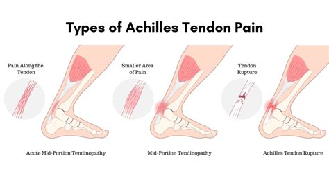 Achilles Tendinopathy: Anatomy, Function, Diagnosis & Treatment