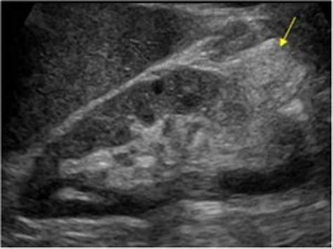 Exophytic angiomyolipoma | Ultrasound sonography, Diagnostic medical sonography, Diagnostic imaging