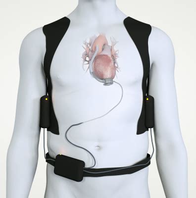 LVAD | Left Ventricular Assist Device | UCHealth | Denver & Colorado