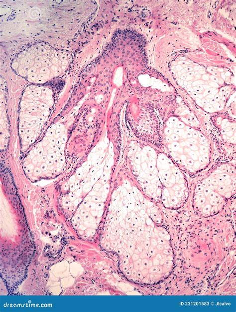 Sebaceous Hyperplasia Histology