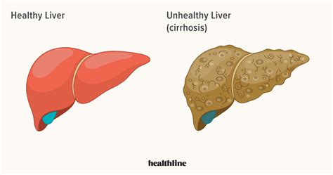 Liver Disease: Types of Liver Problems, Causes, and More