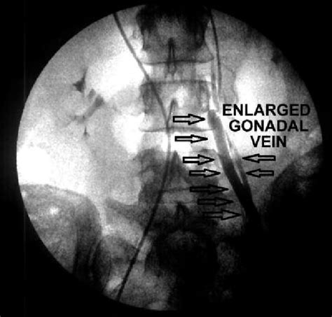 The fluoroscopic image demonstrates enlarged gonadal vein in its ...