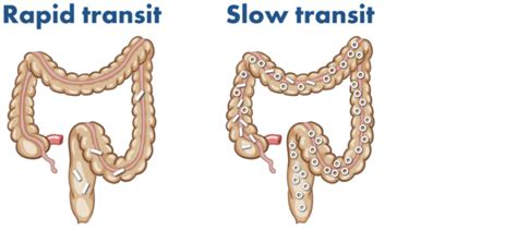 Transit-Pelletsmethod™ - APR Medtech