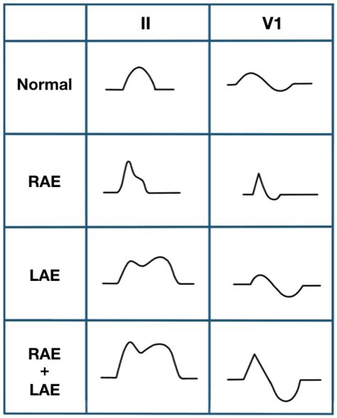 P wave • LITFL • ECG Library Basics