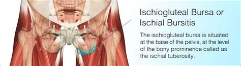 Pin on Pain in the Butt - Ischial Bursitis