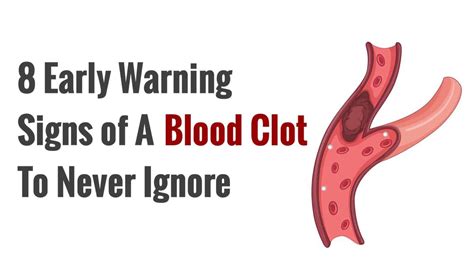 8 Early Warning Signs of A Blood Clot to Never Ignore