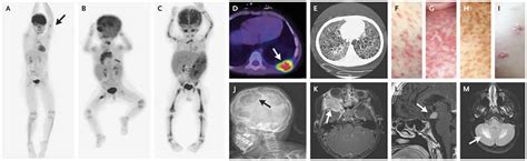 Eosinophilic granuloma causes, symptoms, diagnosis, treatment & prognosis