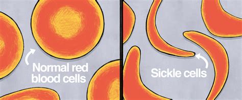 What Is Sickle Cell Disease?