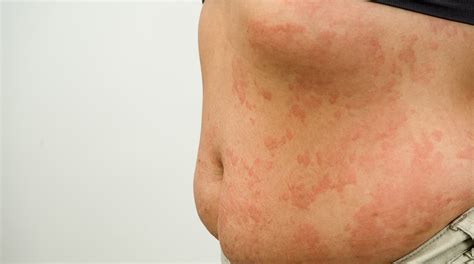 A Quick Overview of Cold Urticaria Symptoms and Treatment