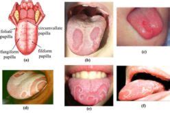 Geographic Tongue Pictures, Symptoms, Treatment, Causes