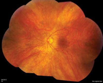 AUTOIMMUNE RETINOPATHY: THE RETINA INSTITUTE BOARD CERTIFIED RETINAL ...