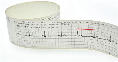 PR Interval - The Definitive Guide | Biology Dictionary