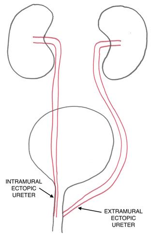 Ectopic Ureters