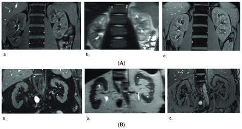 Examples of T1, T2, and T2* MRI in (A/a) 35-year-old, healthy man with ...