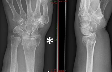 Distal Radial Fracture – Fife Virtual Hand Clinic