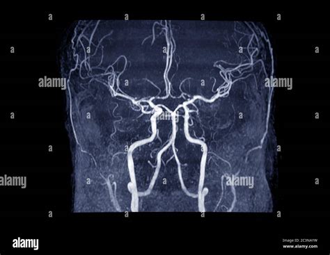 MRA Brain or Magnetic resonance angiography ( MRA ) of cerebral artery in the brain for evaluate ...