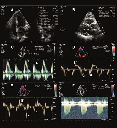 Critical Analysis and Limitations of the Diagnosis of Heart Failure with Preserved Ejection ...