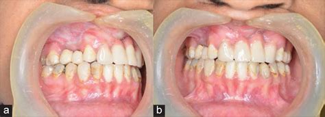 Treatment of severe maxillary cleft hypoplasia in a case with missing premaxilla with anterior ...