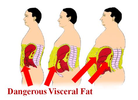 10 Horrible Diseases Caused By Carrying Too Much Visceral (Belly) Fat & How To Eliminate Your ...