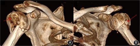 Fracture morphology with varus position. A varus fracture illustrated a... | Download Scientific ...