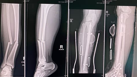 Fundraiser by Kelly Ha : Tibial and Fibula Fracture