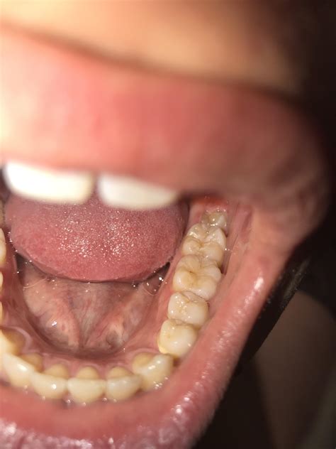 Do I have a cavity in my first mollar? It looks like a small black spot. : r/Dentistry