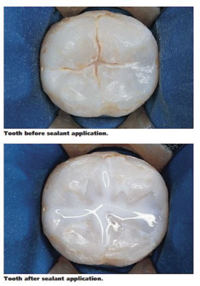 What are fissure sealants and why should my child have them? - Kiddies Dental Care