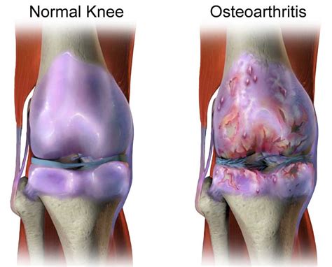 Knee Osteoarthritis - Diagnosis, Treatment & Therapy | Dr. Scott Naftulin